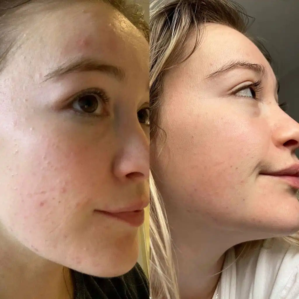 Douvall’s Douvall’s - Argan Acne Rehab Natural Skincare Serum with Hempseed Oil 2592 - Health & Beauty > Personal Care > Cosmetics > Skin Care > Lotion & Moisturize > Face Oils & Serums emmy-jane-boutique.myshopify.com