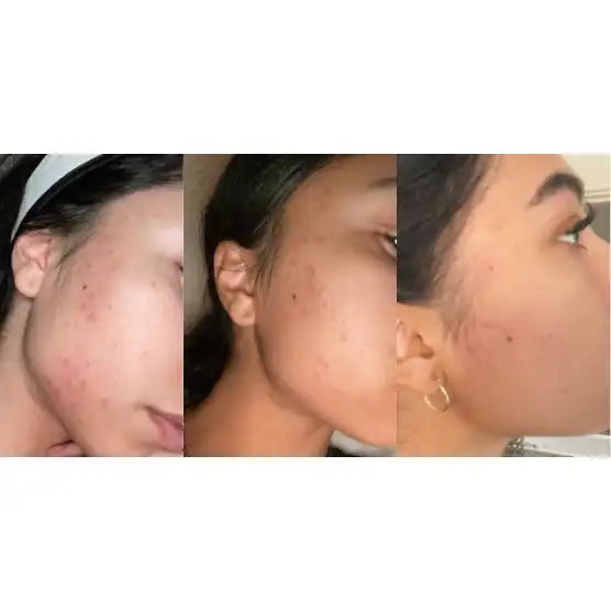 Douvall’s Douvall’s - Argan Acne Rehab Natural Skincare Serum with Hempseed Oil 2592 - Health & Beauty > Personal Care > Cosmetics > Skin Care > Lotion & Moisturize > Face Oils & Serums emmy-jane-boutique.myshopify.com