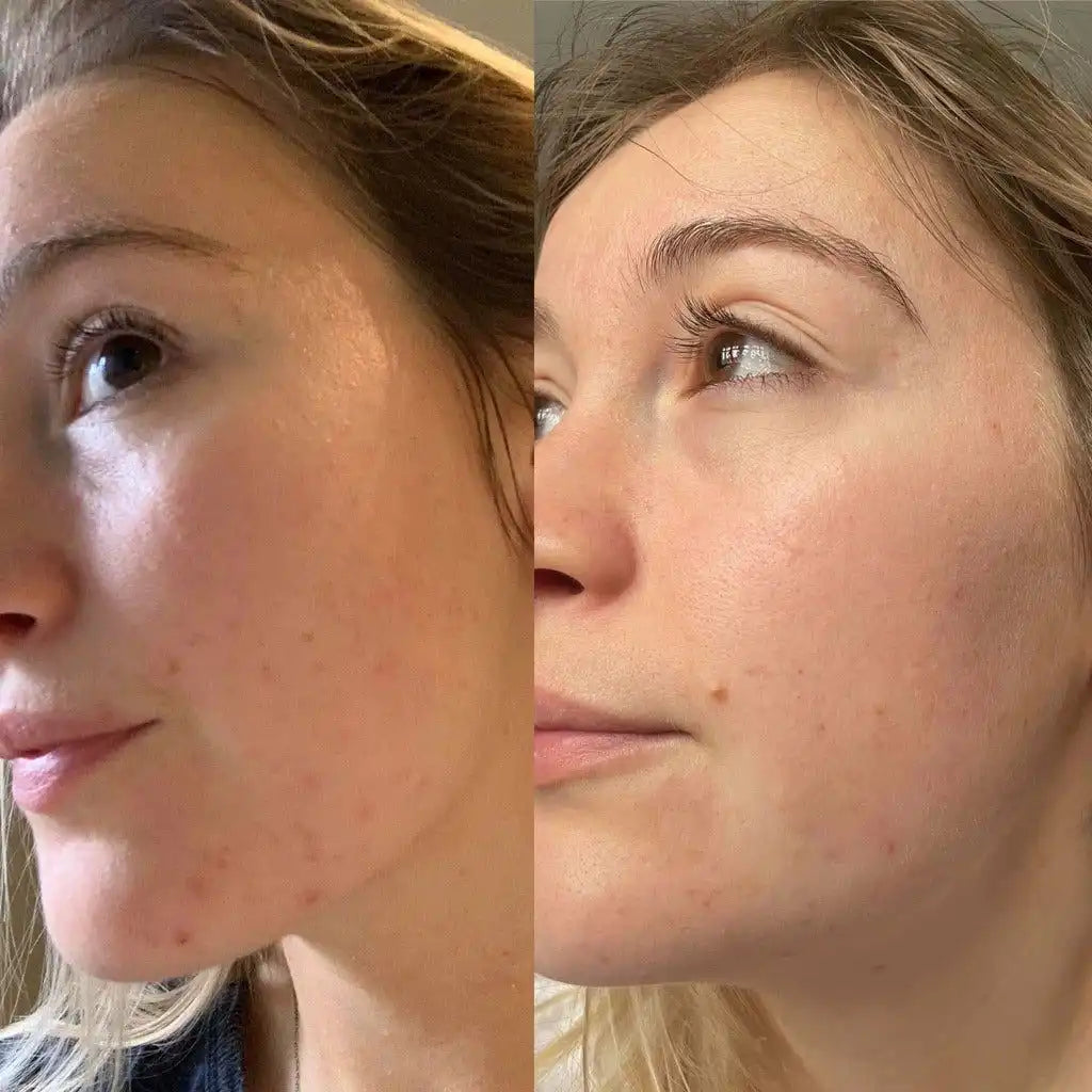 Douvall’s Douvall’s - Argan Acne Rehab Natural Skincare Serum with Hempseed Oil 2592 - Health & Beauty > Personal Care > Cosmetics > Skin Care > Lotion & Moisturize > Face Oils & Serums emmy-jane-boutique.myshopify.com