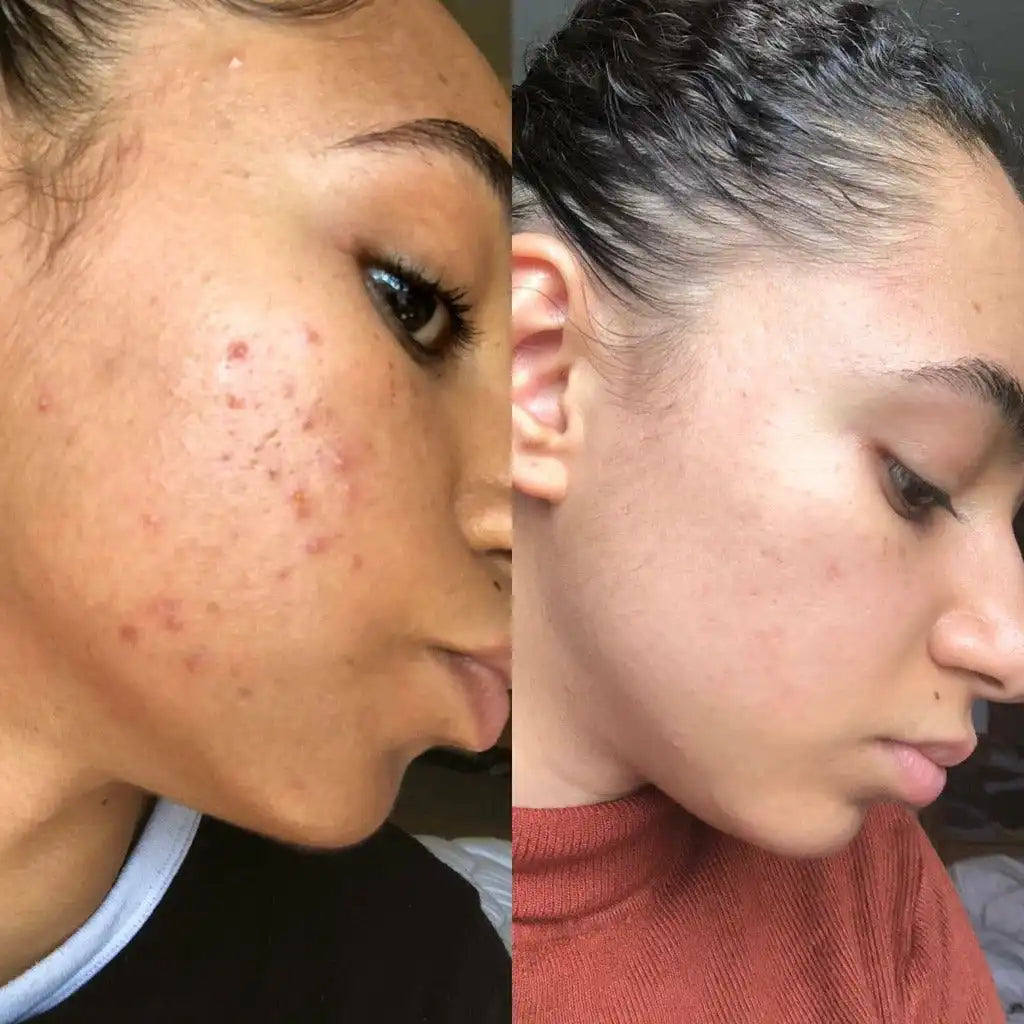 Douvall’s Douvall’s - Argan Acne Rehab Natural Skincare Serum with Hempseed Oil 2592 - Health & Beauty > Personal Care > Cosmetics > Skin Care > Lotion & Moisturize > Face Oils & Serums emmy-jane-boutique.myshopify.com