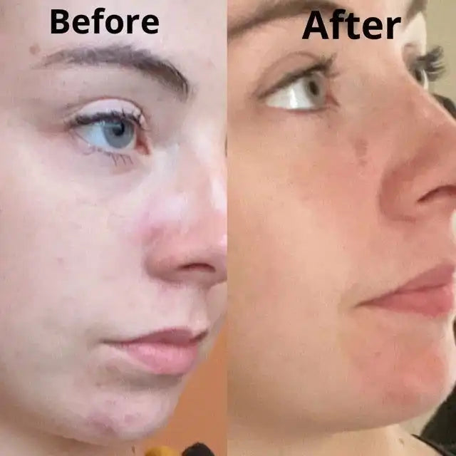 Douvall’s Douvall’s - Argan Acne Rehab Natural Skincare Serum with Hempseed Oil 2592 - Health & Beauty > Personal Care > Cosmetics > Skin Care > Lotion & Moisturize > Face Oils & Serums emmy-jane-boutique.myshopify.com